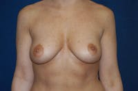 Breast Augmentation Before & After Gallery - Patient 277057 - Image 1