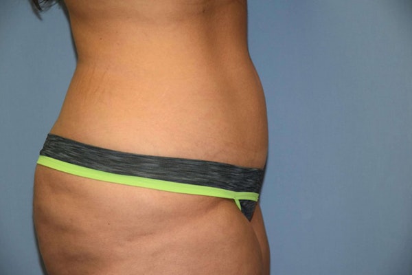 Tummy Tuck Before & After Gallery - Patient 119198 - Image 4