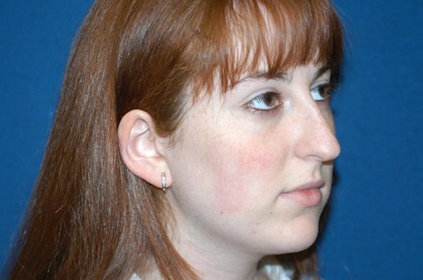 Rhinoplasty Before & After Gallery - Patient 126925 - Image 5