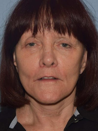 Facelift Before & After Gallery - Patient 382744 - Image 2