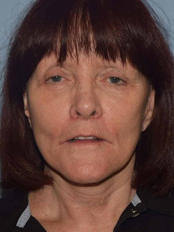 Facelift Before & After Gallery - Patient 382744 - Image 2
