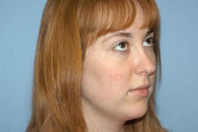 Rhinoplasty Before & After Gallery - Patient 126925 - Image 6