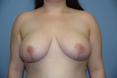 Breast Reduction Before & After Gallery - Patient 380357 - Image 2
