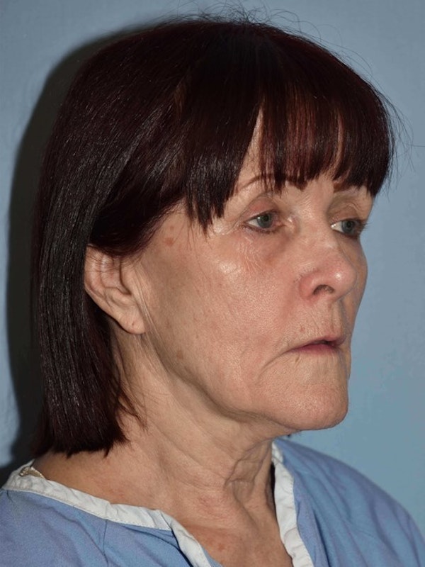 Facelift Before & After Gallery - Patient 382744 - Image 3