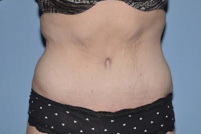 Tummy Tuck Before & After Gallery - Patient 332659 - Image 2