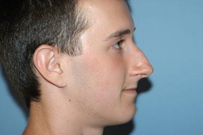 Rhinoplasty Before & After Gallery - Patient 354982 - Image 1