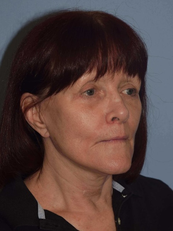 Facelift Before & After Gallery - Patient 382744 - Image 4