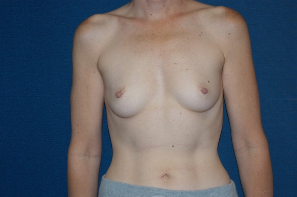 Breast Augmentation Before & After Gallery - Patient 161282 - Image 1