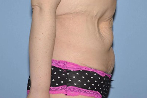 Tummy Tuck Before & After Gallery - Patient 332659 - Image 5