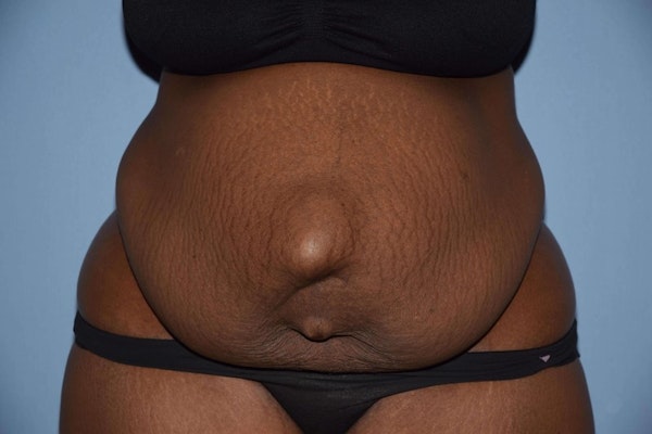 Before and After Abdominoplasty in Long Island