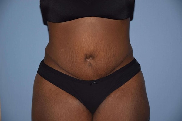 Before and After Abdominoplasty in Long Island