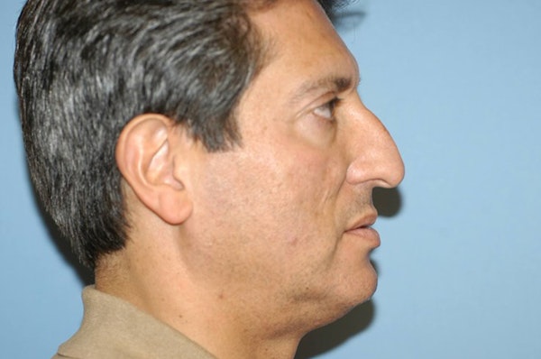 Rhinoplasty Before & After Gallery - Patient 201079 - Image 1