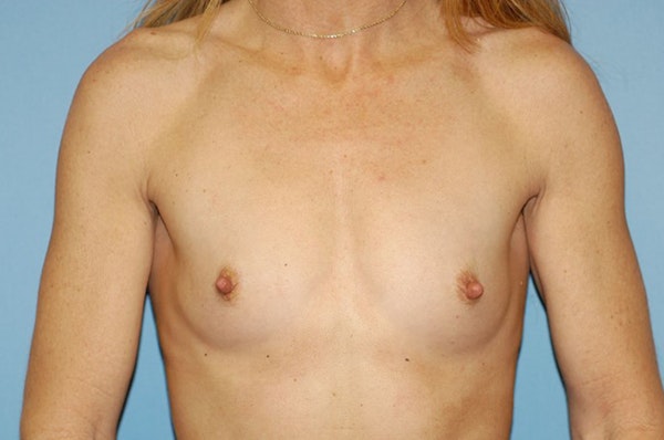 Breast Augmentation Before & After Gallery - Patient 142041 - Image 1