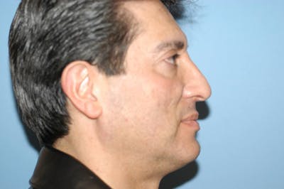 Rhinoplasty Before & After Gallery - Patient 201079 - Image 2
