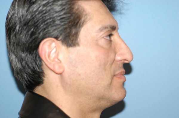 Rhinoplasty Before & After Gallery - Patient 201079 - Image 2