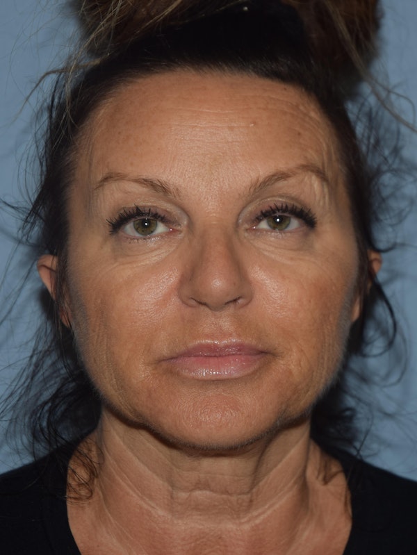 Facelift Before & After Gallery - Patient 480100 - Image 1