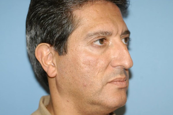 Rhinoplasty Before & After Gallery - Patient 201079 - Image 5