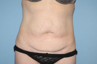 Tummy Tuck Before & After Gallery - Patient 963341 - Image 1