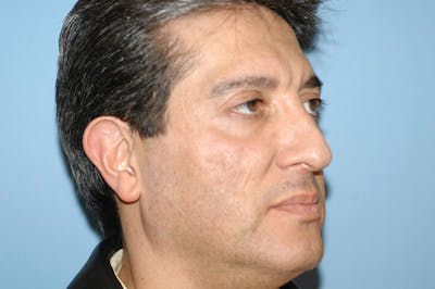 Rhinoplasty Before & After Gallery - Patient 201079 - Image 6