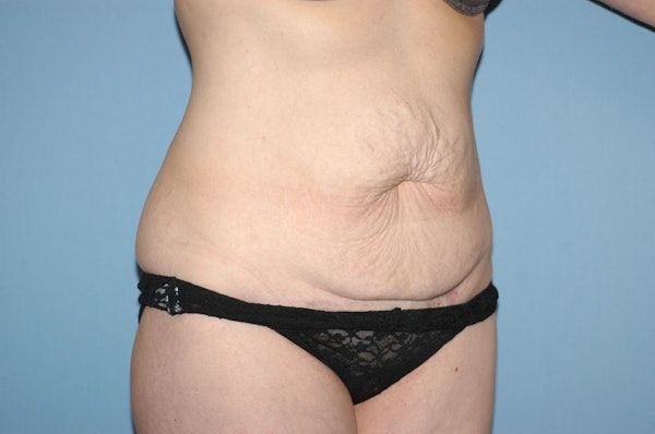 Tummy Tuck Before & After Gallery - Patient 963341 - Image 3