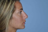 Rhinoplasty Before & After Gallery - Patient 234497 - Image 1