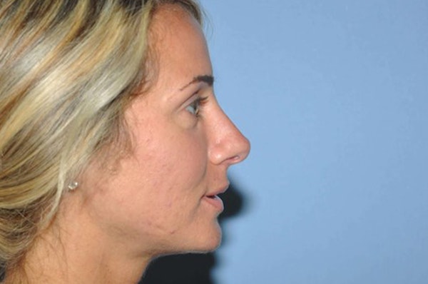 Rhinoplasty Before & After Gallery - Patient 234497 - Image 2