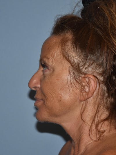 Facelift Before & After Gallery - Patient 480100 - Image 4