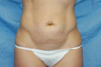 Tummy Tuck Before & After Gallery - Patient 221196 - Image 1