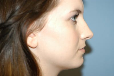 Rhinoplasty Before & After Gallery - Patient 135857 - Image 1