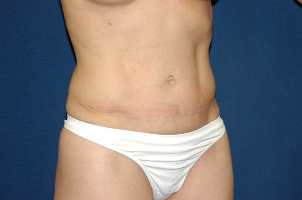 Tummy Tuck Before & After Gallery - Patient 221196 - Image 4