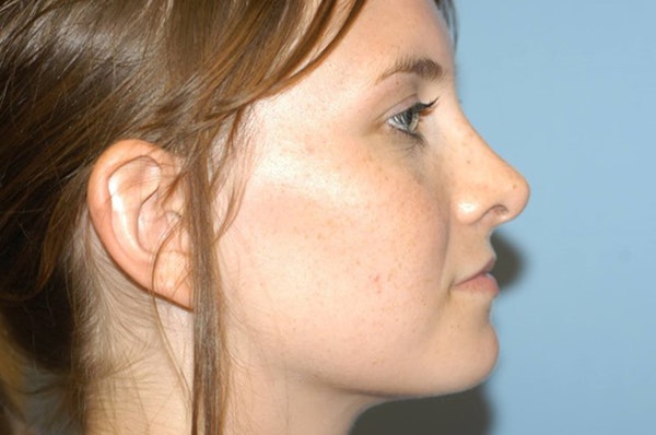 Rhinoplasty Before & After Gallery - Patient 135857 - Image 2