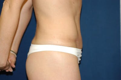 Tummy Tuck Before & After Gallery - Patient 221196 - Image 6