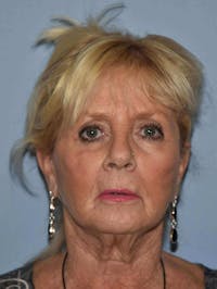 Facelift Before & After Gallery - Patient 102219 - Image 1