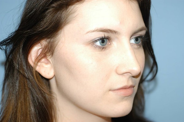 Rhinoplasty Before & After Gallery - Patient 135857 - Image 5