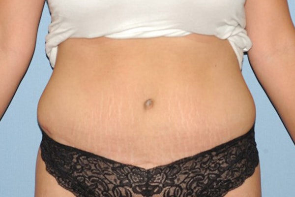 Tummy Tuck Before & After Gallery - Patient 174904 - Image 2