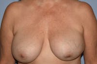 Breast Revision Before & After Gallery - Patient 380588 - Image 1