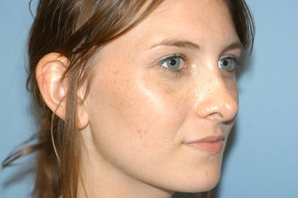 Rhinoplasty Before & After Gallery - Patient 135857 - Image 6