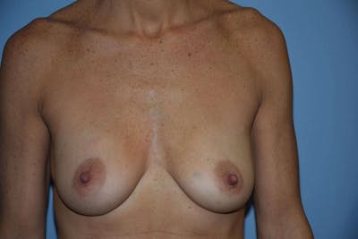 Breast Augmentation Before & After Gallery - Patient 356017 - Image 1