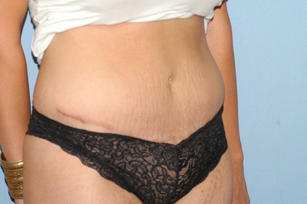 Tummy Tuck Before & After Gallery - Patient 174904 - Image 4