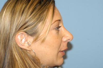 Rhinoplasty Before & After Gallery - Patient 384755 - Image 2