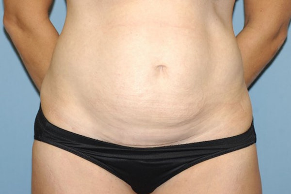 Tummy Tuck Before & After Gallery - Patient 348590 - Image 1