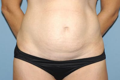 Tummy Tuck Before & After Gallery - Patient 348590 - Image 1