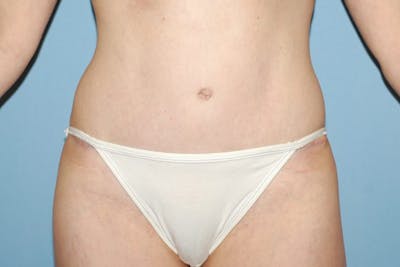 Tummy Tuck Before & After Gallery - Patient 348590 - Image 2