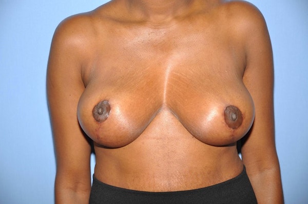 Breast Reduction Before & After Gallery - Patient 343845 - Image 2