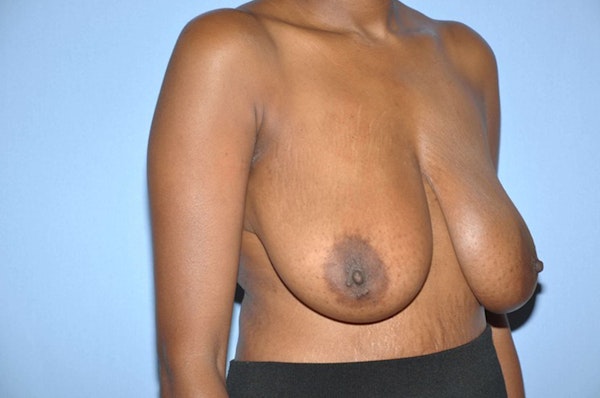 Breast Reduction Before & After Gallery - Patient 343845 - Image 3