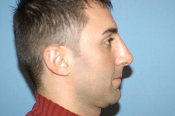 Rhinoplasty Before & After Gallery - Patient 348824 - Image 2