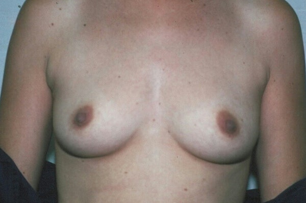 Breast Augmentation Before & After Gallery - Patient 319759 - Image 1