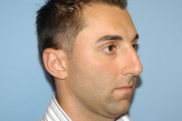 Rhinoplasty Before & After Gallery - Patient 348824 - Image 5