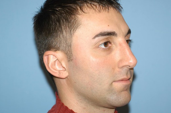 Rhinoplasty Before & After Gallery - Patient 348824 - Image 6