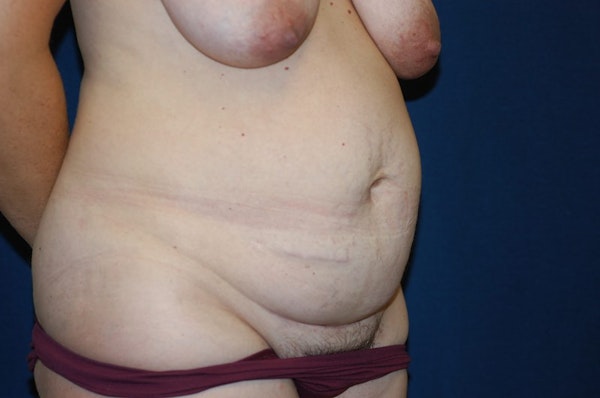 Tummy Tuck Before & After Gallery - Patient 247883 - Image 3